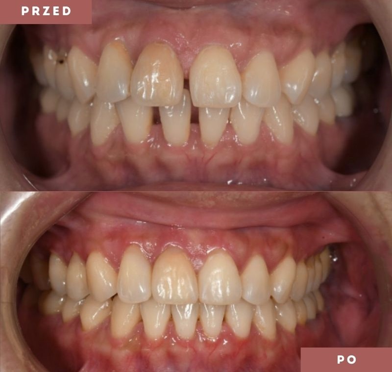 Nakładki ortodontyczne - poznaj ich charakterystykę