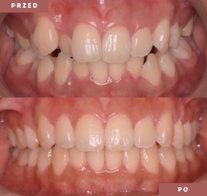 Nakładki ortodontyczne - poznaj ich charakterystykę